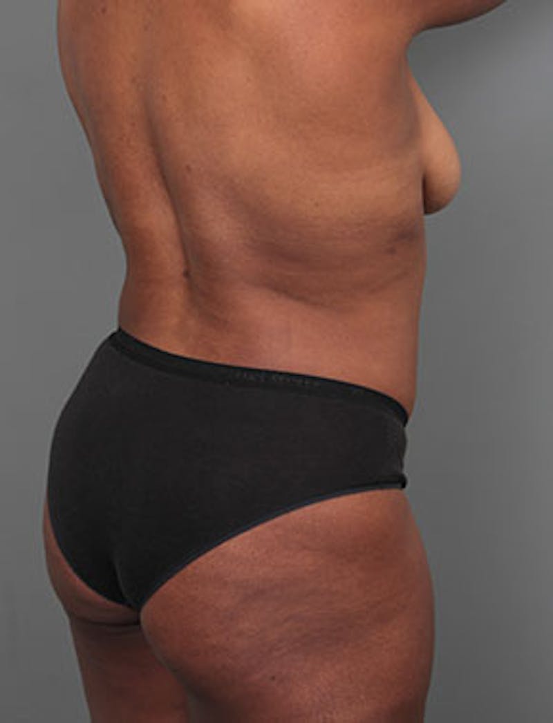Liposuction Before & After Gallery - Patient 349960 - Image 4 - Scott Chapin, MD
