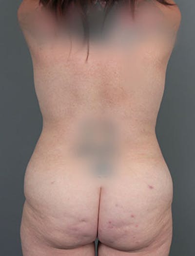 Liposuction Before & After Gallery - Patient 102539 - Image 2 - Scott Chapin, MD