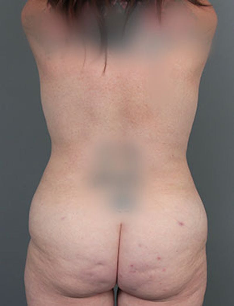 Liposuction Before & After Gallery - Patient 102539 - Image 2 - Scott Chapin, MD