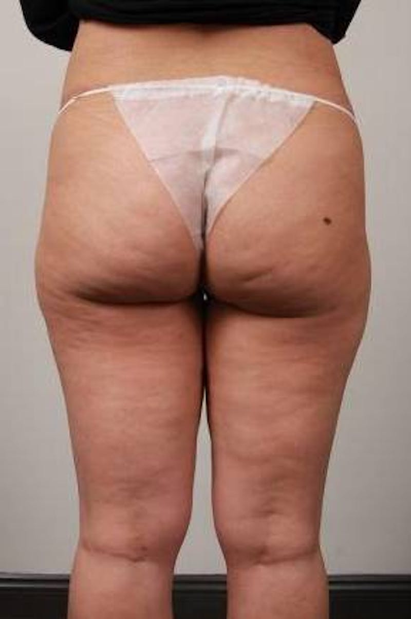 Liposuction Before & After Gallery - Patient 123579 - Image 1 - Scott Chapin, MD