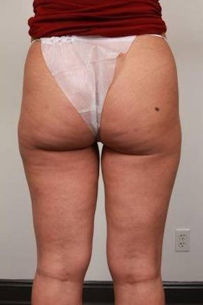 Liposuction Before & After Gallery - Patient 123579 - Image 2 - Scott Chapin, MD