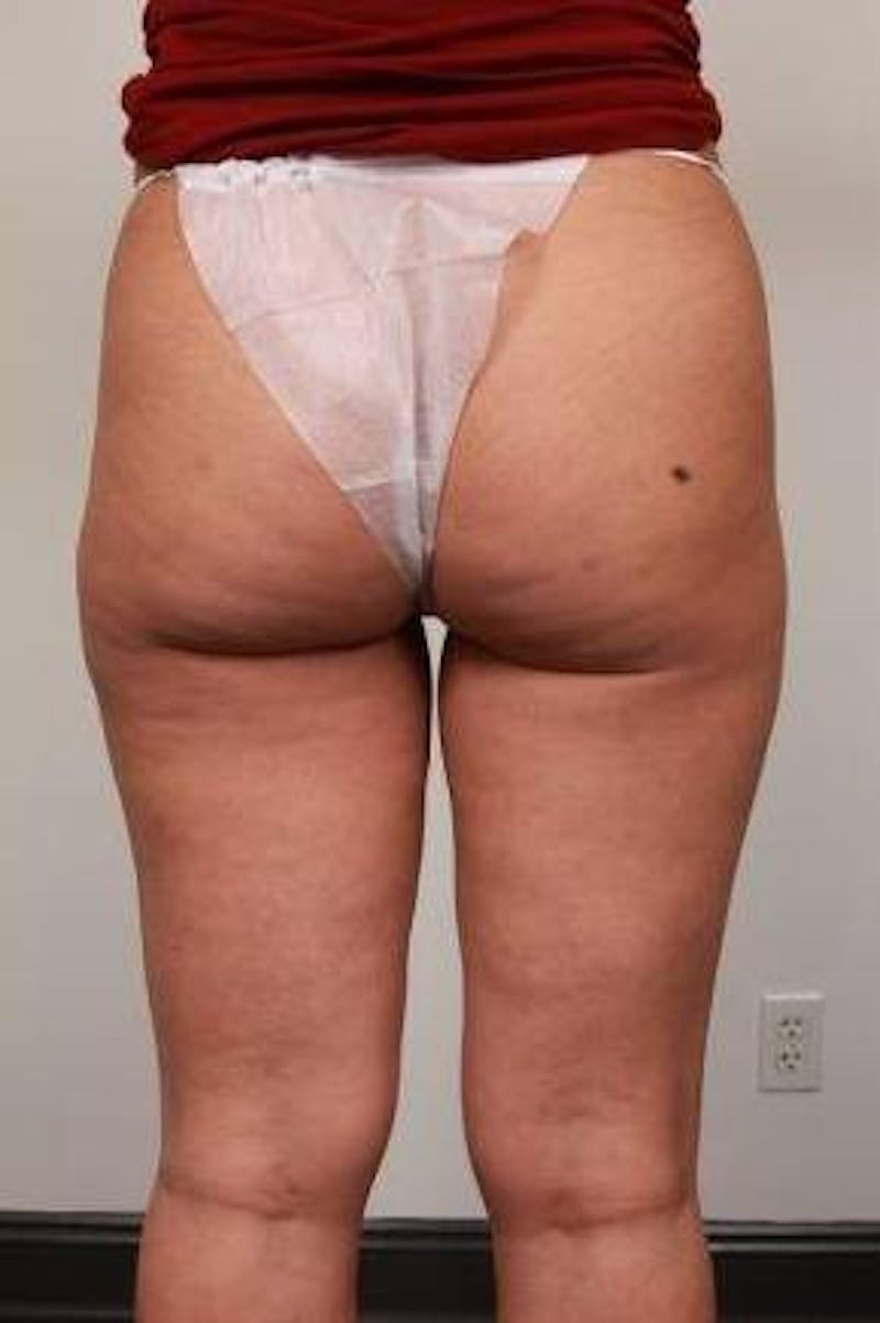 Liposuction Before & After Gallery - Patient 123579 - Image 2 - Scott Chapin, MD