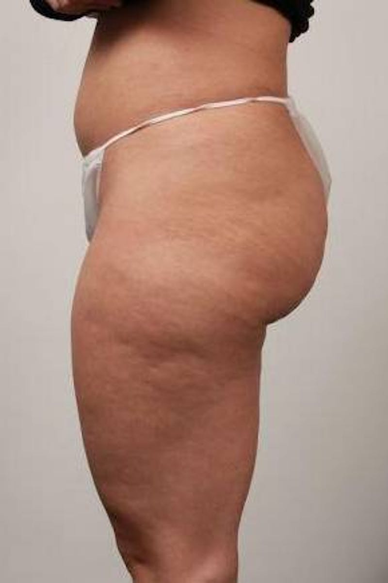 Liposuction Before & After Gallery - Patient 123579 - Image 3 - Scott Chapin, MD