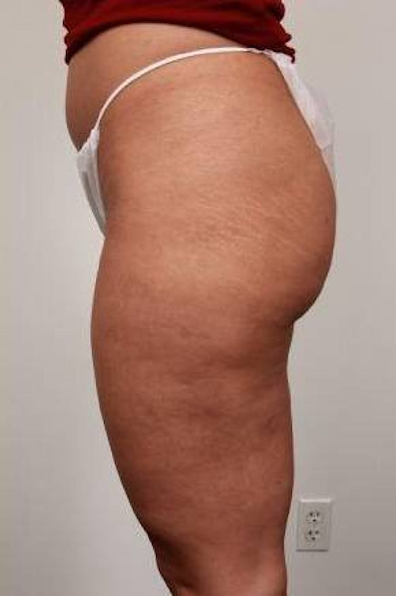 Liposuction Before & After Gallery - Patient 123579 - Image 4 - Scott Chapin, MD
