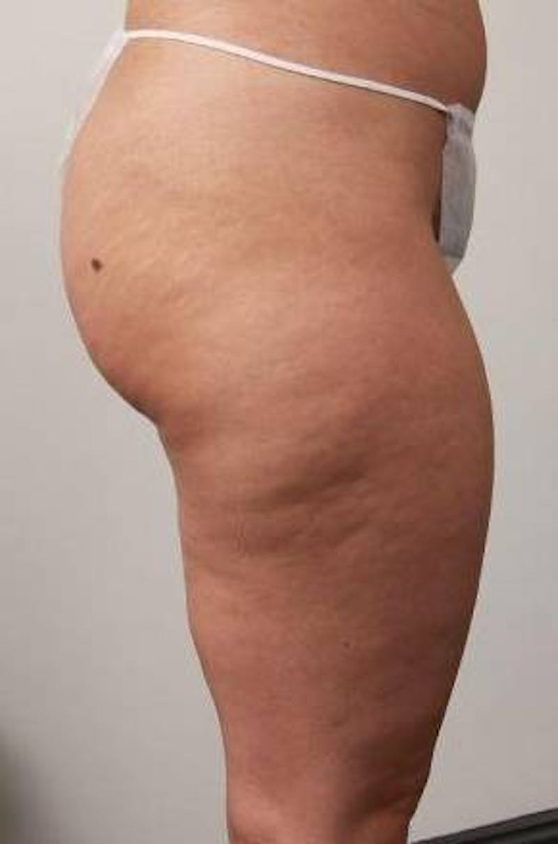 Liposuction Before & After Gallery - Patient 123579 - Image 5 - Scott Chapin, MD