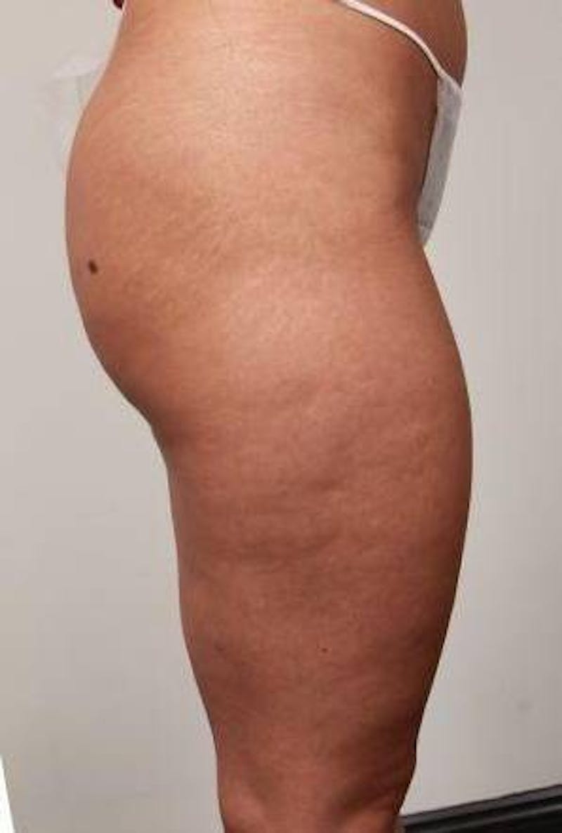 Liposuction Before & After Gallery - Patient 123579 - Image 6 - Scott Chapin, MD