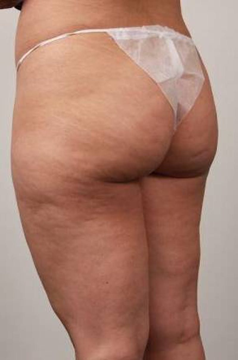 Liposuction Before & After Gallery - Patient 123579 - Image 7 - Scott Chapin, MD