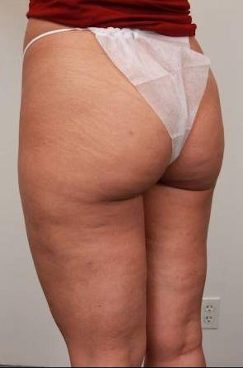 Liposuction Before & After Gallery - Patient 123579 - Image 8 - Scott Chapin, MD