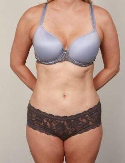 Liposuction Before & After Gallery - Patient 161287 - Image 2 - Scott Chapin, MD