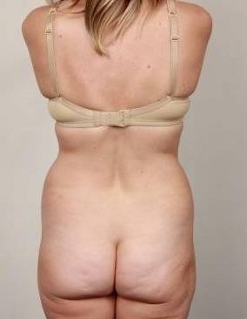 Liposuction Before & After Gallery - Patient 161287 - Image 3 - Scott Chapin, MD