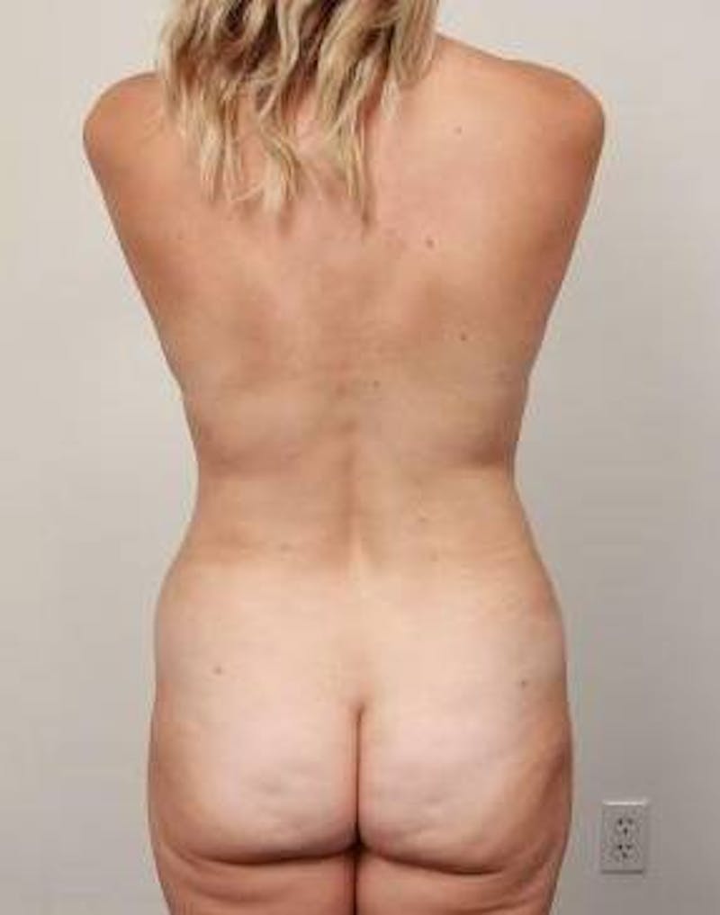 Liposuction Before & After Gallery - Patient 161287 - Image 4 - Scott Chapin, MD