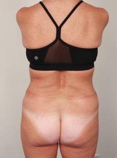 Liposuction Before & After Gallery - Patient 228847 - Image 1 - Scott Chapin, MD