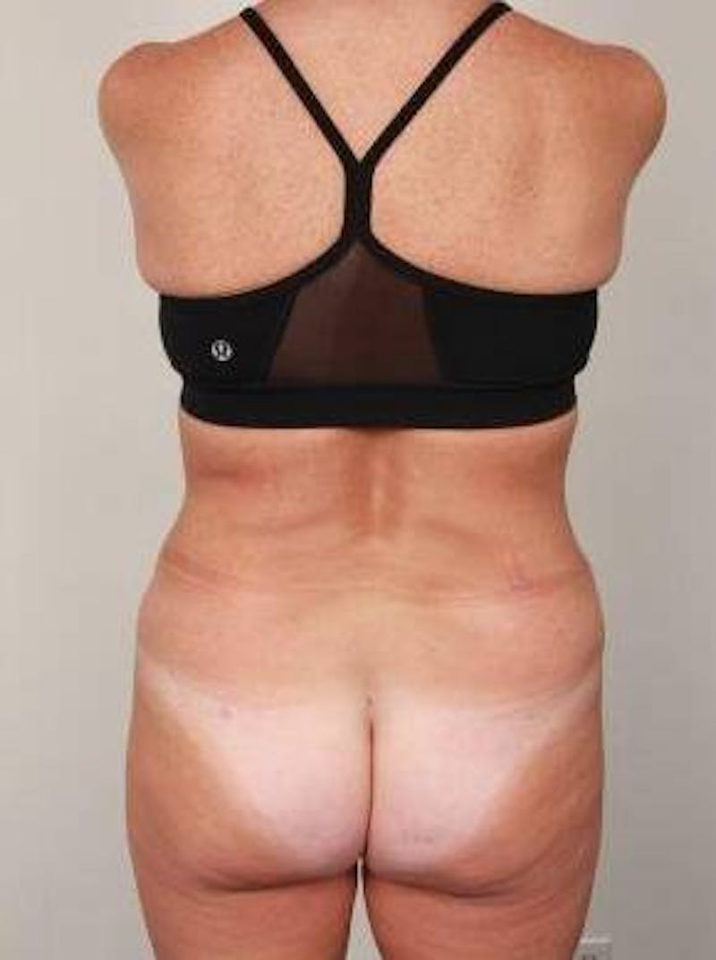 Liposuction Before & After Gallery - Patient 228847 - Image 1 - Scott Chapin, MD
