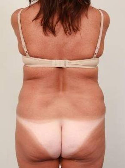 Liposuction Before & After Gallery - Patient 228847 - Image 2 - Scott Chapin, MD