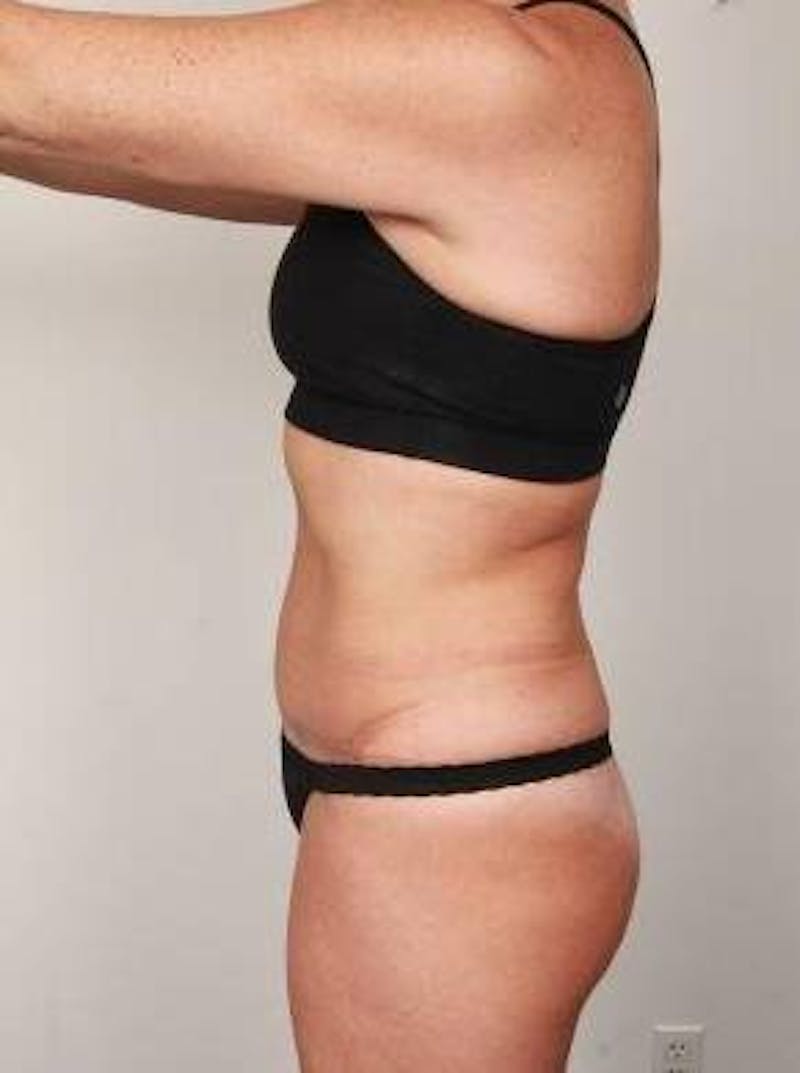 Liposuction Before & After Gallery - Patient 228847 - Image 3 - Scott Chapin, MD