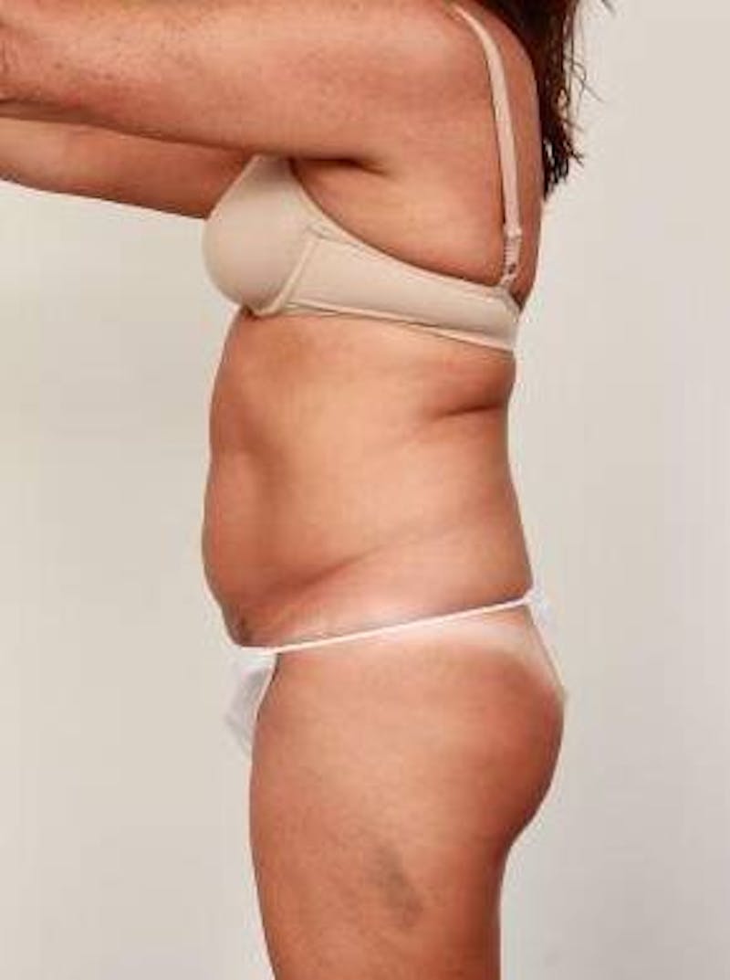 Liposuction Before & After Gallery - Patient 228847 - Image 4 - Scott Chapin, MD
