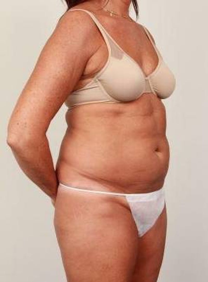 Liposuction Before & After Gallery - Patient 228847 - Image 5 - Scott Chapin, MD