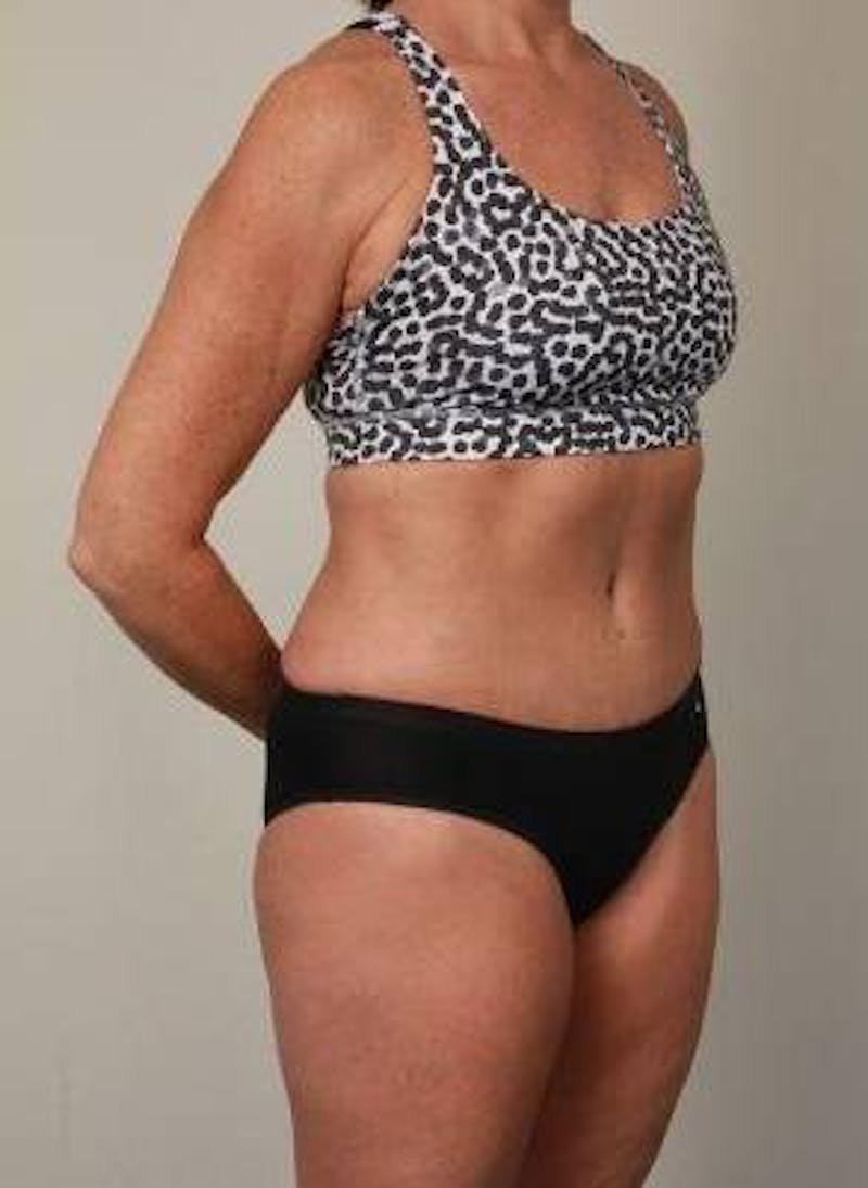 Liposuction Before & After Gallery - Patient 228847 - Image 6 - Scott Chapin, MD
