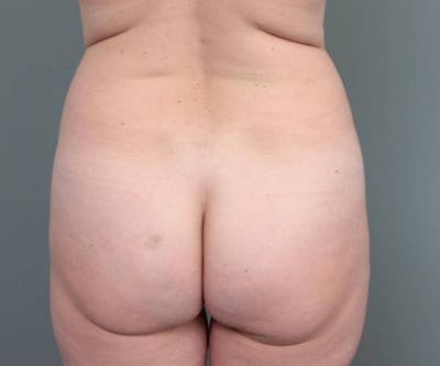 Liposuction Before & After Gallery - Patient 180617 - Image 1 - Scott Chapin, MD