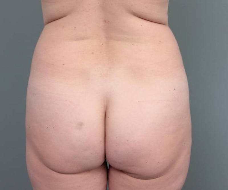 Liposuction Before & After Gallery - Patient 180617 - Image 1 - Scott Chapin, MD