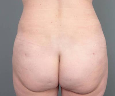 Liposuction Before & After Gallery - Patient 180617 - Image 2 - Scott Chapin, MD