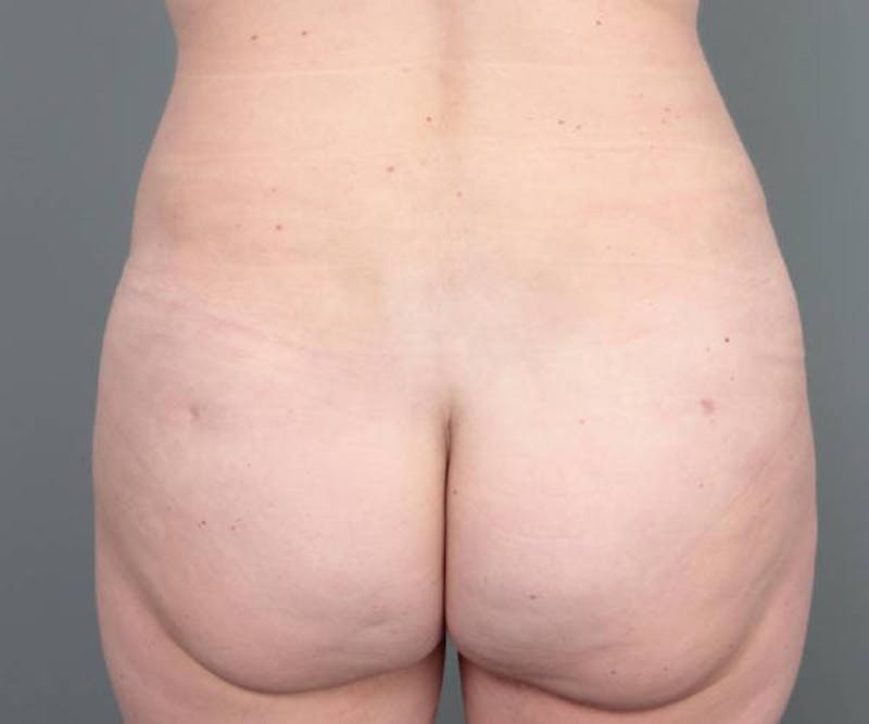 Liposuction Before & After Gallery - Patient 180617 - Image 2 - Scott Chapin, MD