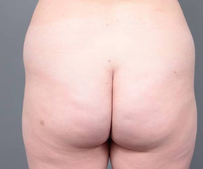 Liposuction Before & After Gallery - Patient 265012 - Image 1 - Scott Chapin, MD