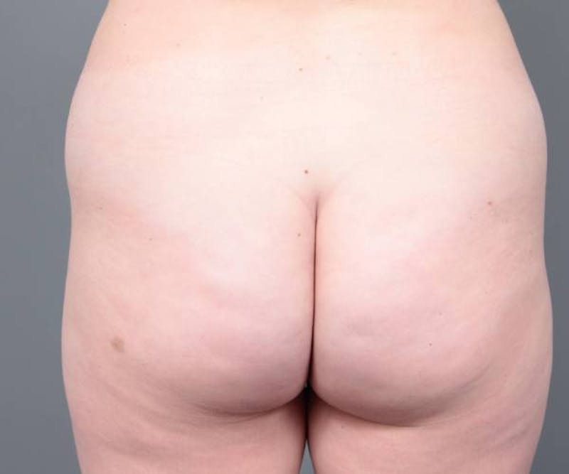 Liposuction Before & After Gallery - Patient 265012 - Image 1 - Scott Chapin, MD
