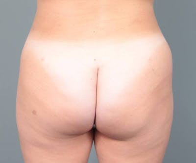 Liposuction Before & After Gallery - Patient 265012 - Image 2 - Scott Chapin, MD