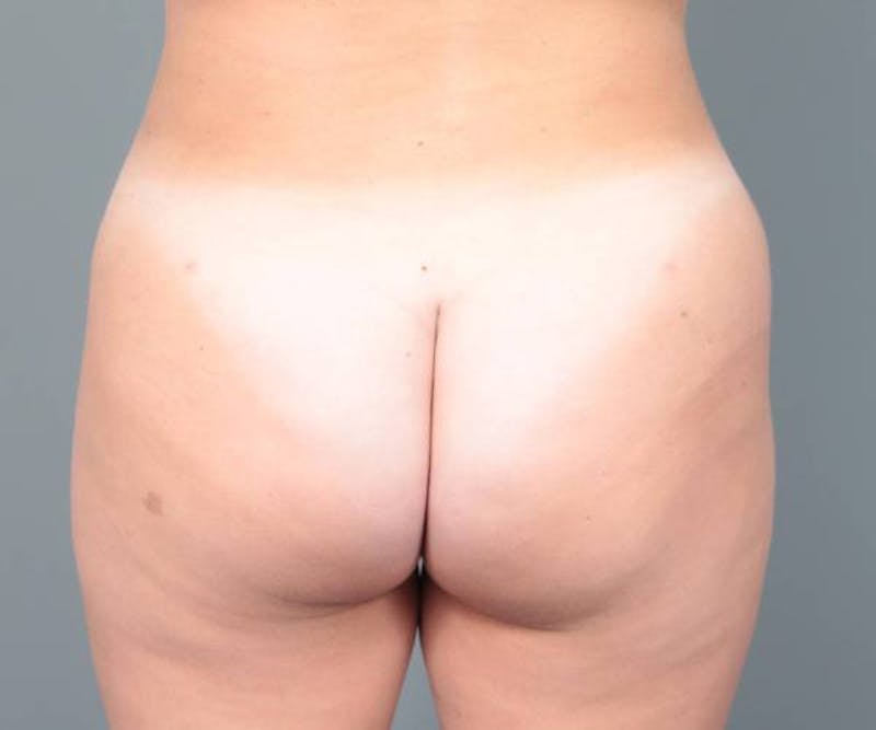 Liposuction Before & After Gallery - Patient 265012 - Image 2 - Scott Chapin, MD
