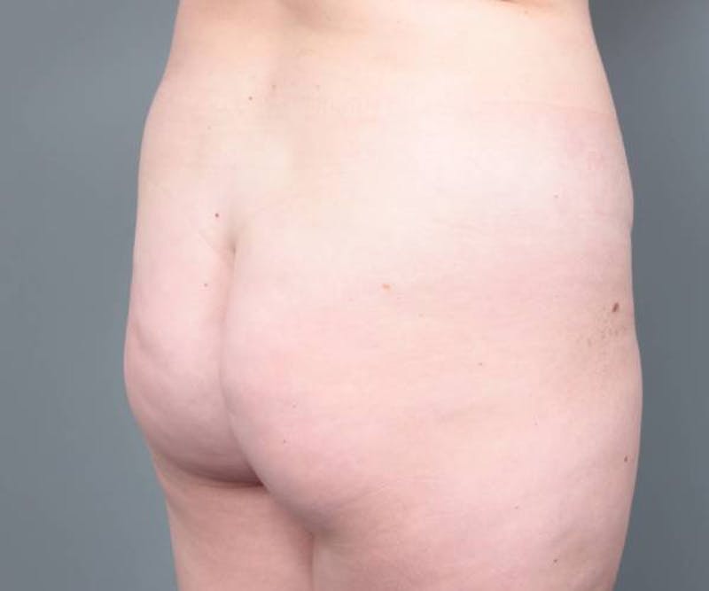 Liposuction Before & After Gallery - Patient 265012 - Image 3 - Scott Chapin, MD