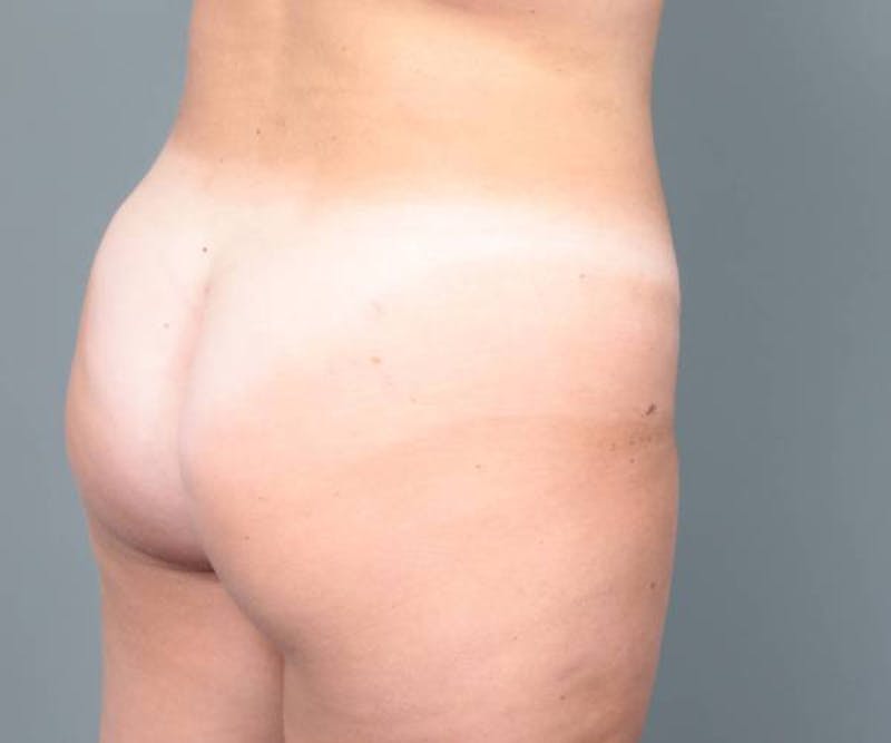 Liposuction Before & After Gallery - Patient 265012 - Image 4 - Scott Chapin, MD