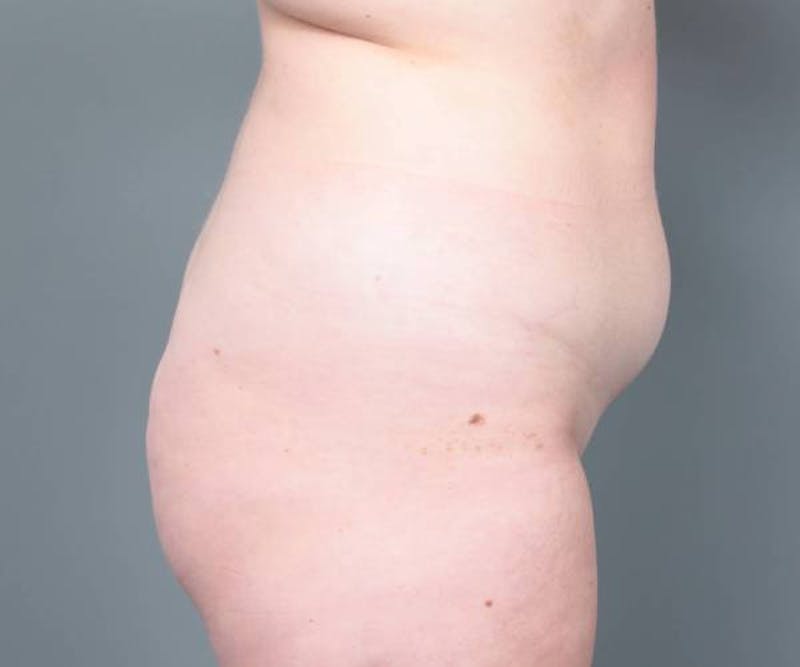 Liposuction Before & After Gallery - Patient 265012 - Image 5 - Scott Chapin, MD