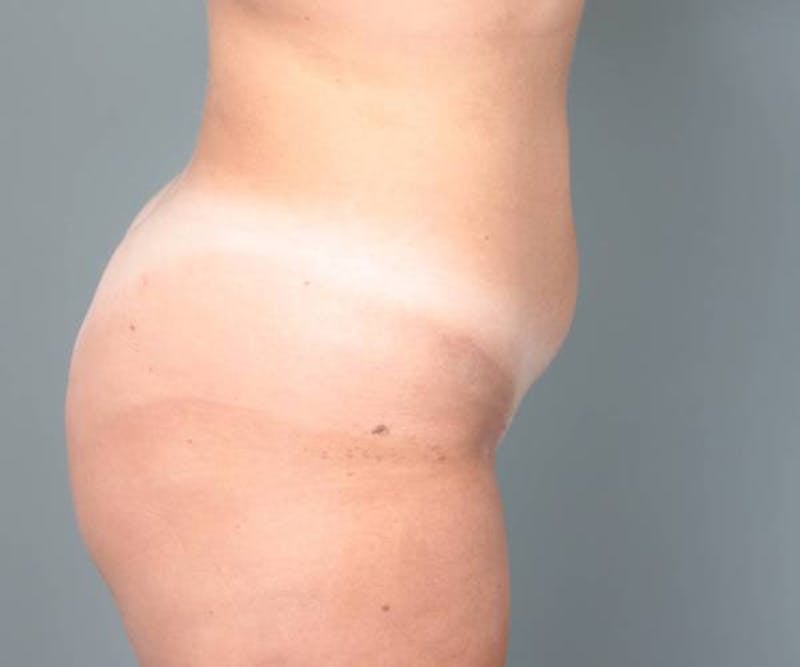 Liposuction Before & After Gallery - Patient 265012 - Image 6 - Scott Chapin, MD