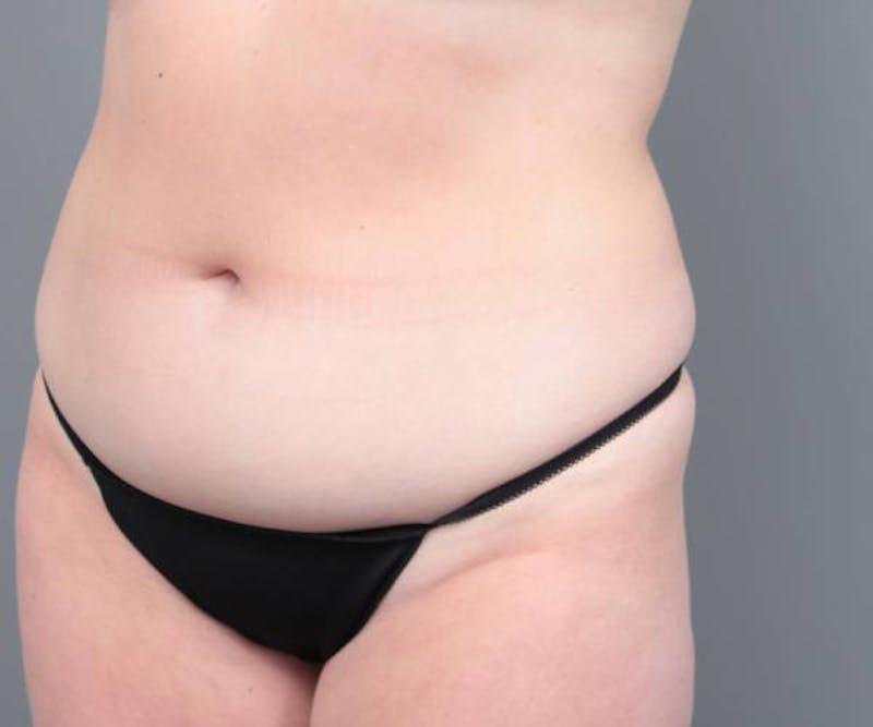 Liposuction Before & After Gallery - Patient 265012 - Image 7 - Scott Chapin, MD
