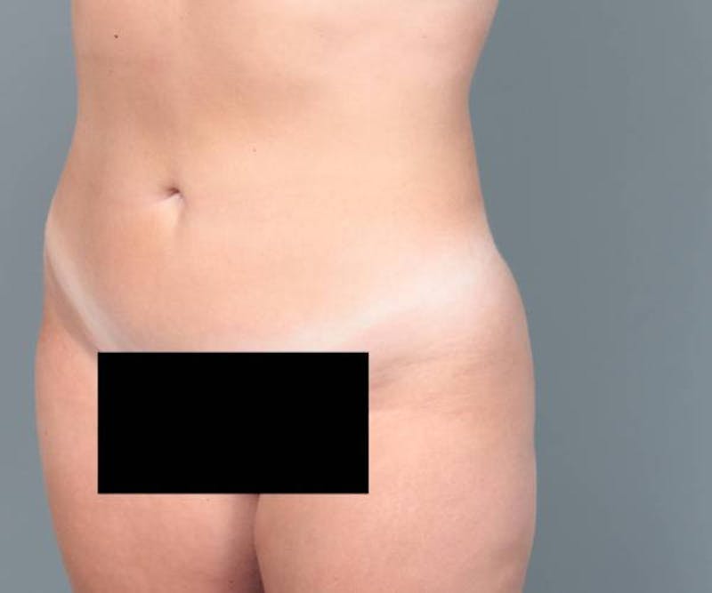 Liposuction Before & After Gallery - Patient 265012 - Image 8 - Scott Chapin, MD