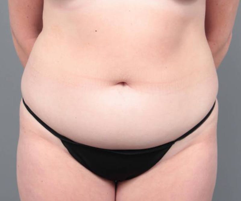 Liposuction Before & After Gallery - Patient 265012 - Image 9 - Scott Chapin, MD