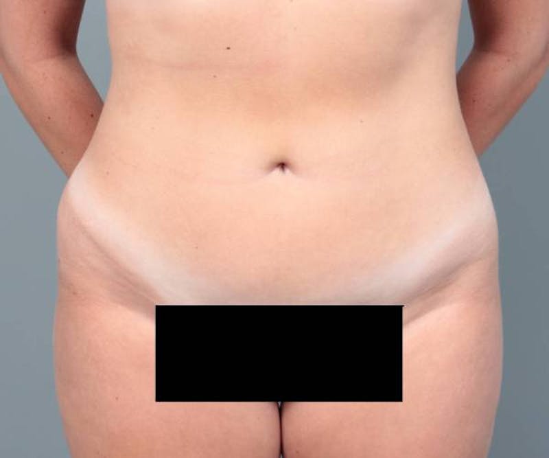 Liposuction Before & After Gallery - Patient 265012 - Image 10 - Scott Chapin, MD