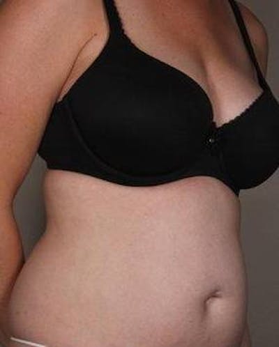 Liposuction Before & After Gallery - Patient 130776 - Image 1 - Scott Chapin, MD