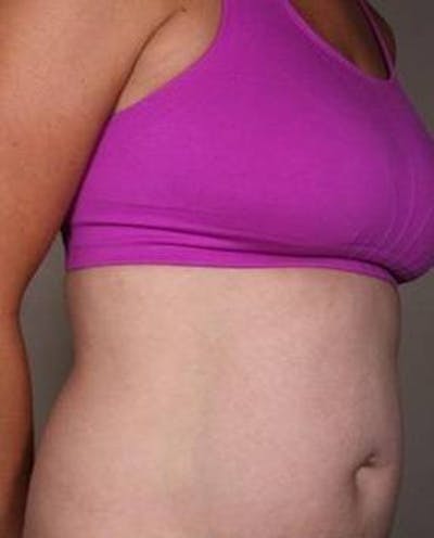 Liposuction Before & After Gallery - Patient 130776 - Image 2 - Scott Chapin, MD