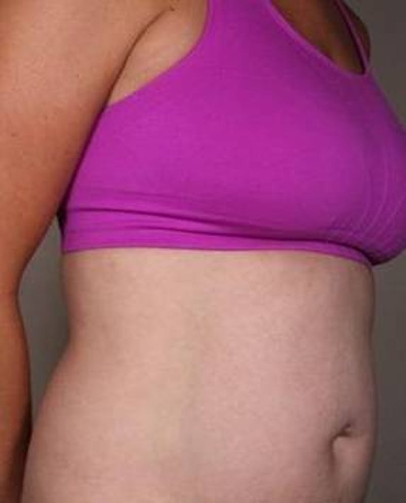 Liposuction Before & After Gallery - Patient 130776 - Image 2 - Scott Chapin, MD