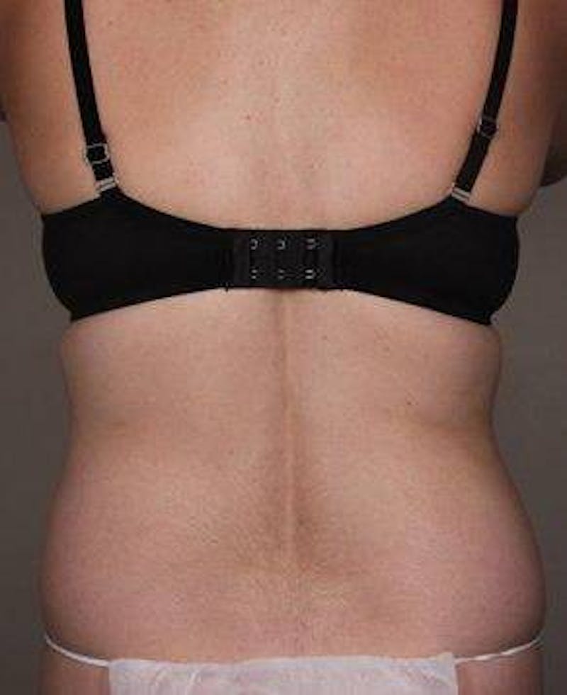 Liposuction Before & After Gallery - Patient 130776 - Image 3 - Scott Chapin, MD