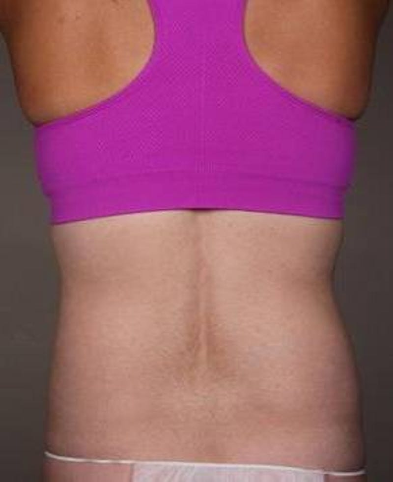 Liposuction Before & After Gallery - Patient 130776 - Image 4 - Scott Chapin, MD