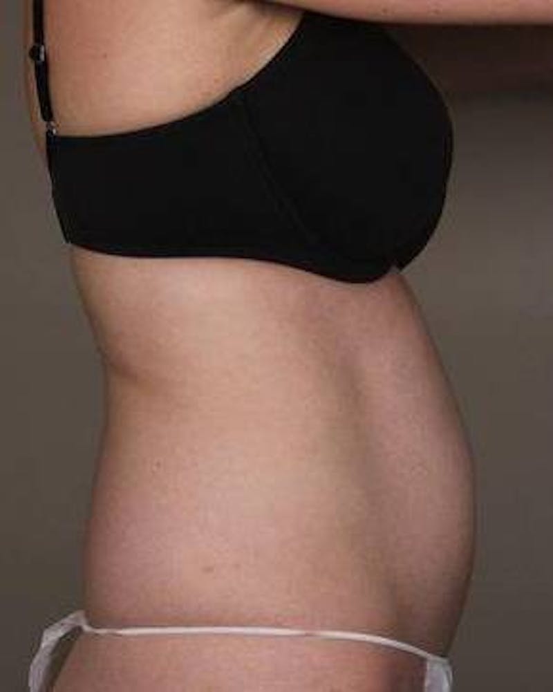 Liposuction Before & After Gallery - Patient 130776 - Image 5 - Scott Chapin, MD