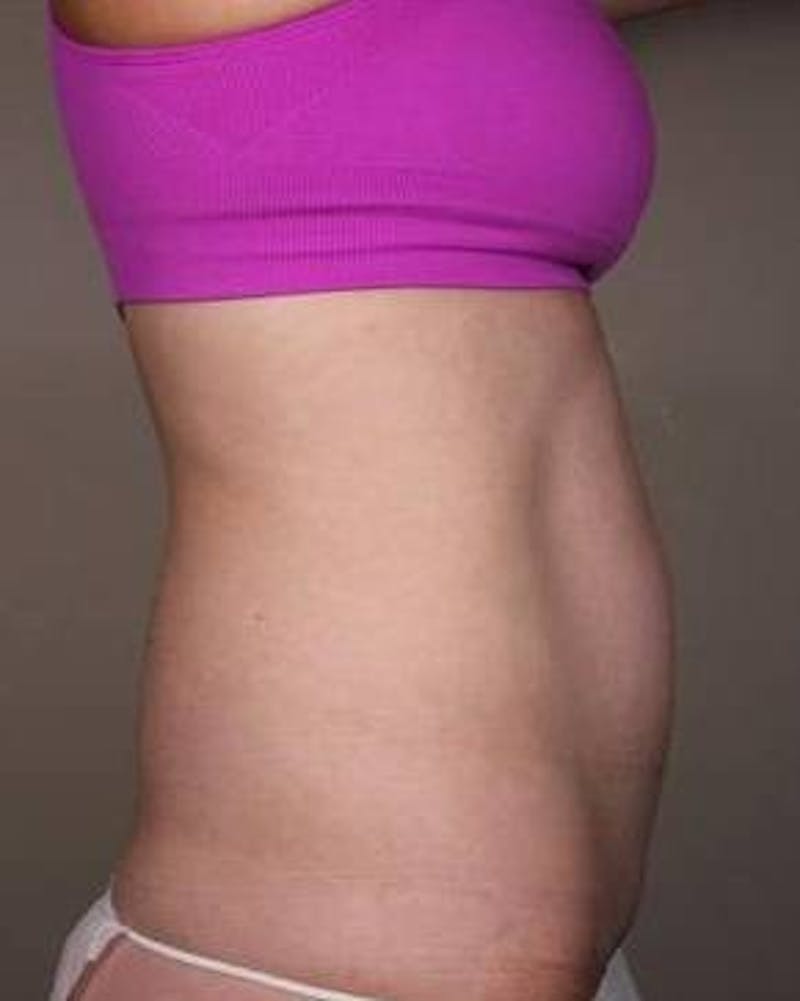 Liposuction Before & After Gallery - Patient 130776 - Image 6 - Scott Chapin, MD