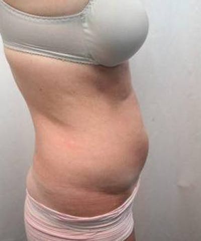 Liposuction Before & After Gallery - Patient 289220 - Image 1 - Scott Chapin, MD