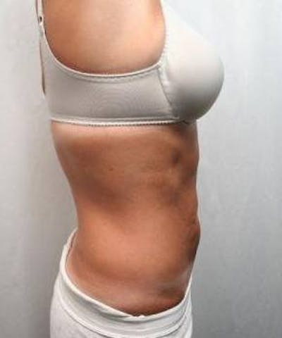 Liposuction Before & After Gallery - Patient 289220 - Image 2 - Scott Chapin, MD