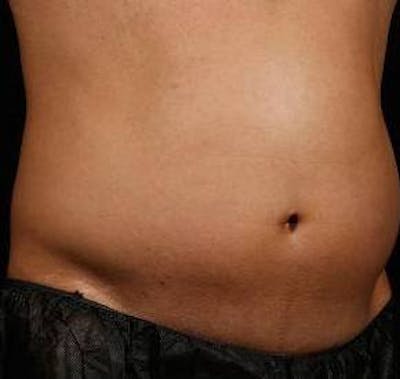 Liposuction Before & After Gallery - Patient 149435 - Image 1 - Scott Chapin, MD