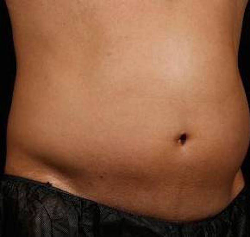 Liposuction Before & After Gallery - Patient 149435 - Image 1 - Scott Chapin, MD