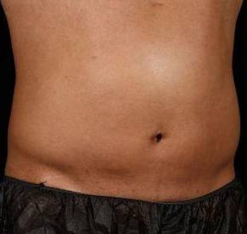 Liposuction Before & After Gallery - Patient 149435 - Image 2 - Scott Chapin, MD